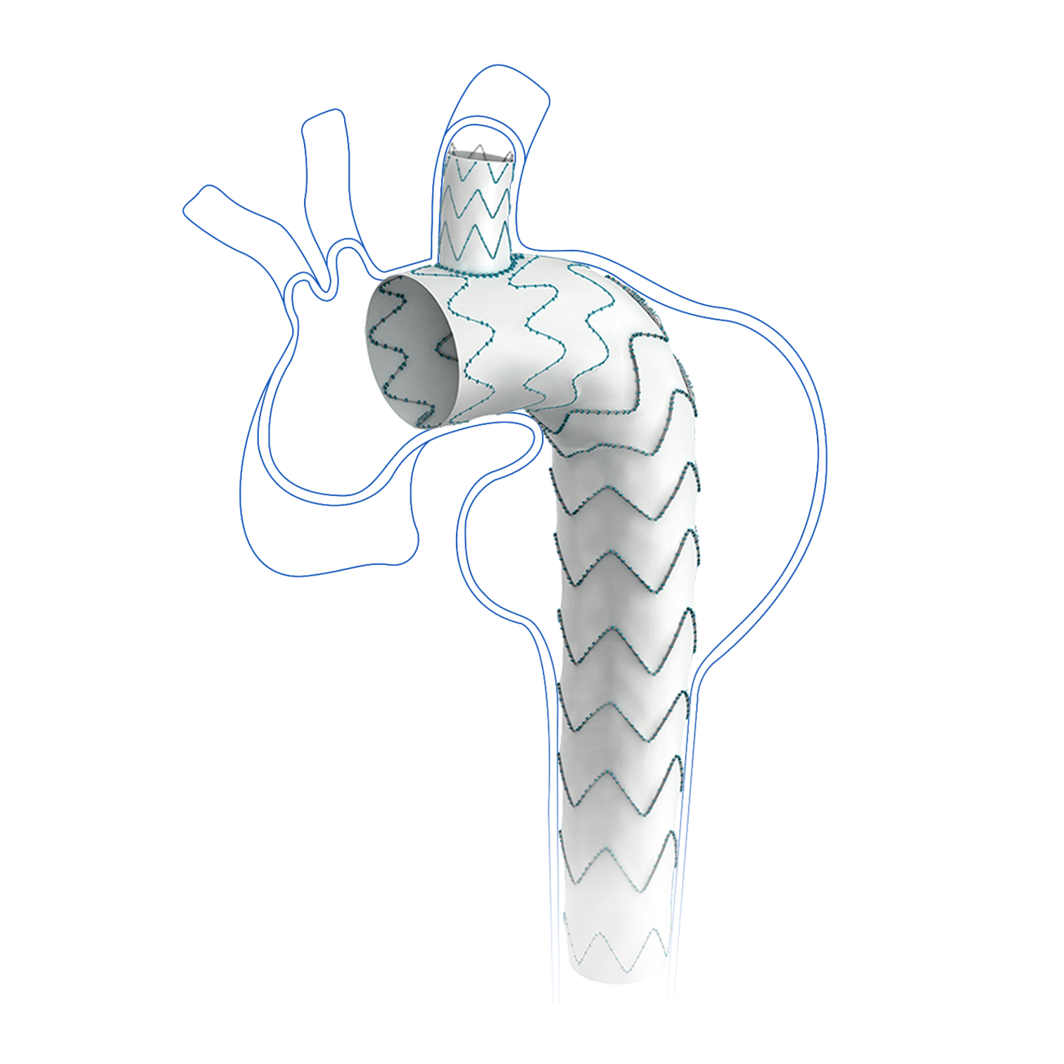 Cratos? Branched Aortic Stent Graft System